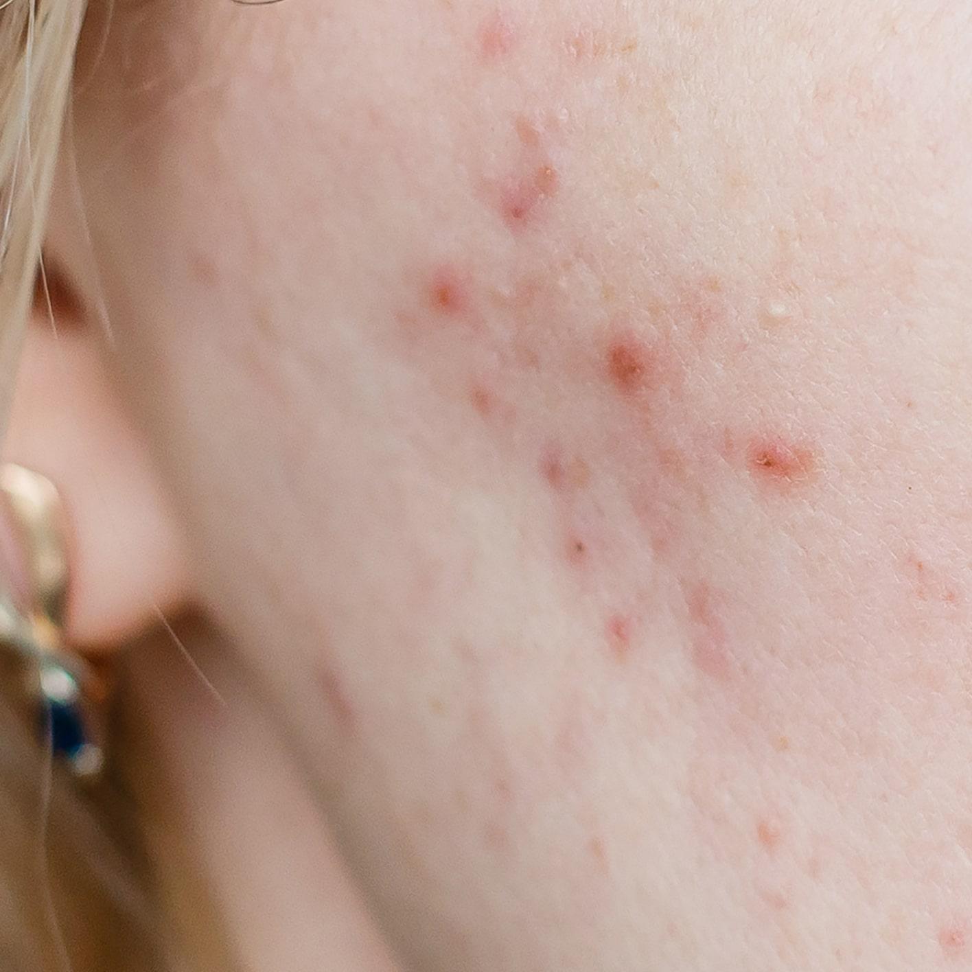 Acne