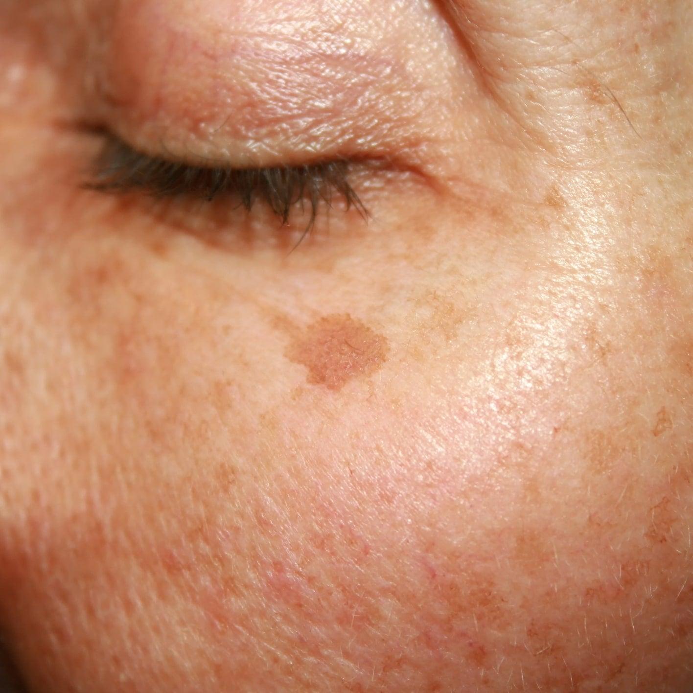 Pigmentation