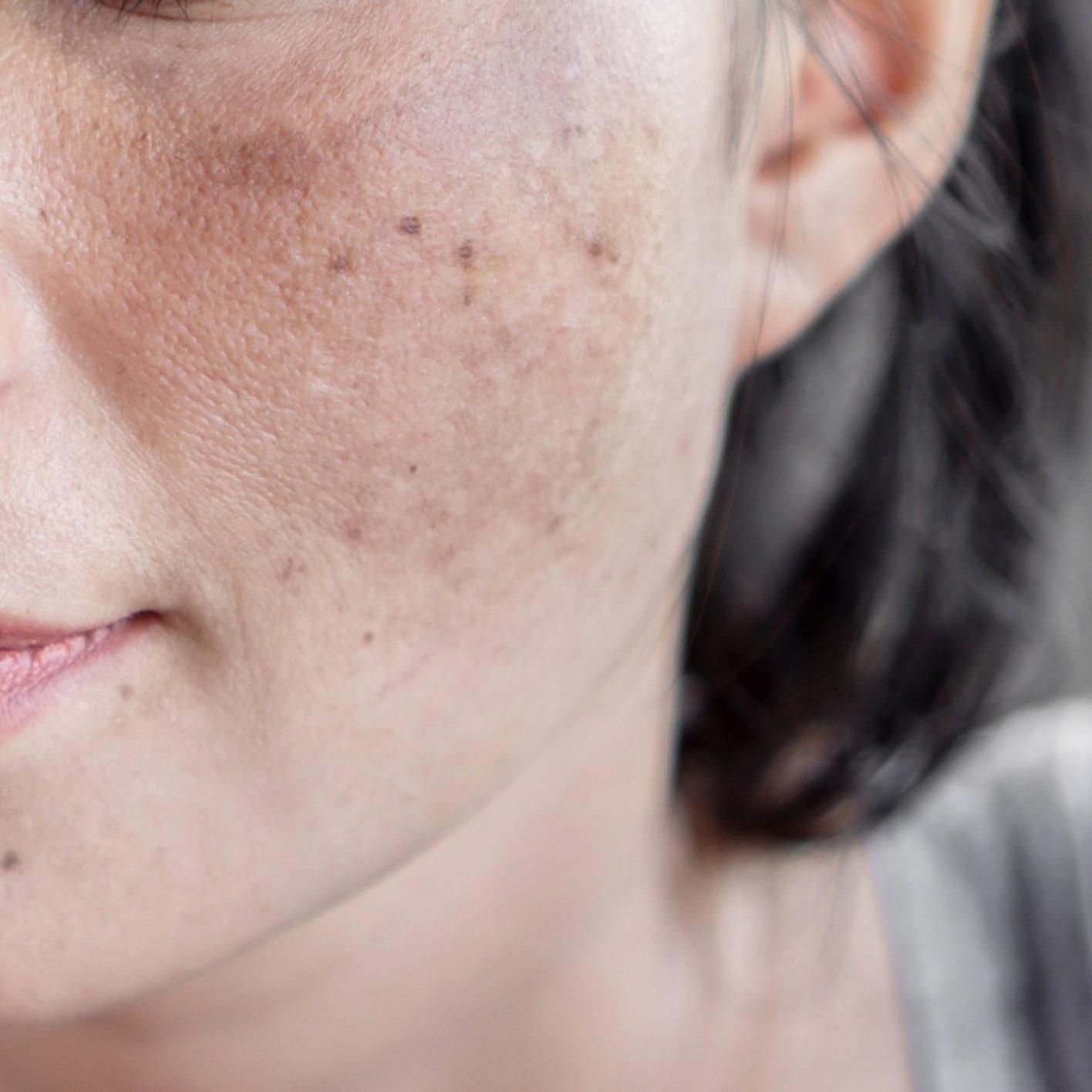 Melasma
