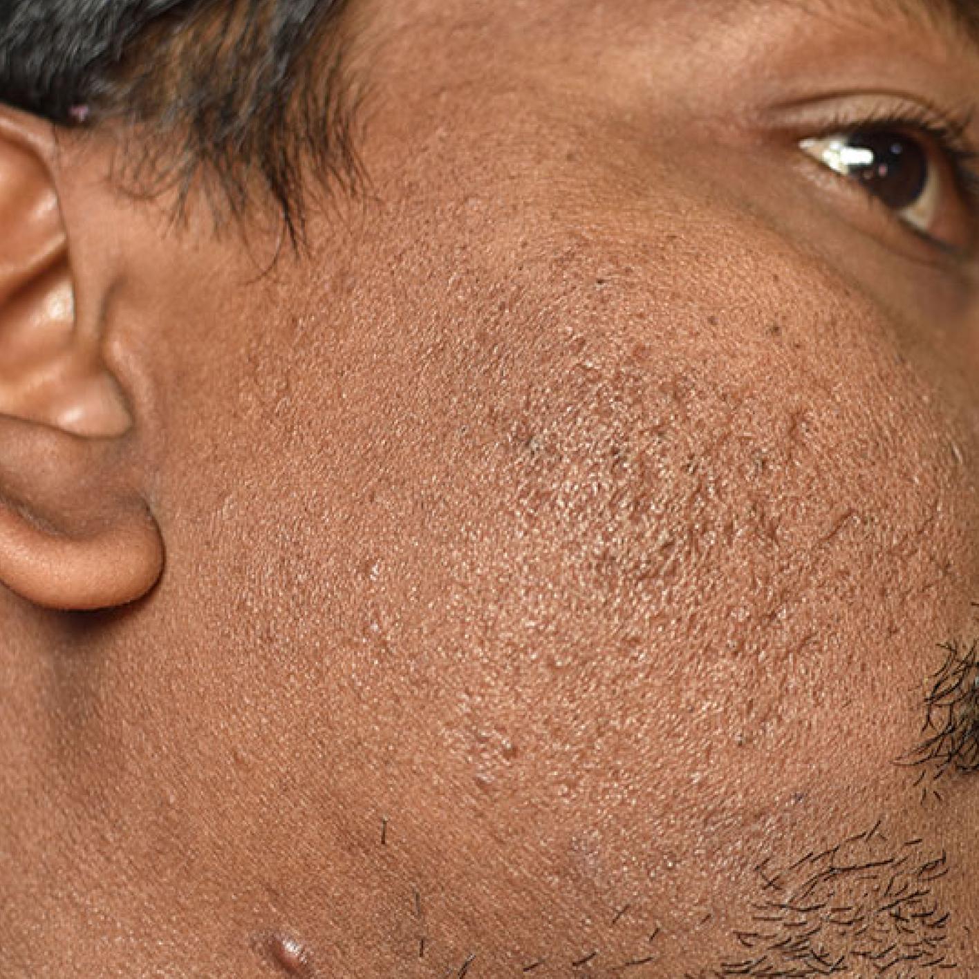 Acne scars