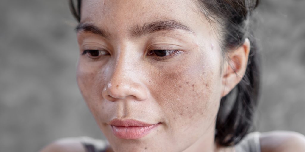 How Can I Get Rid Of My Melasma Sun Moustache