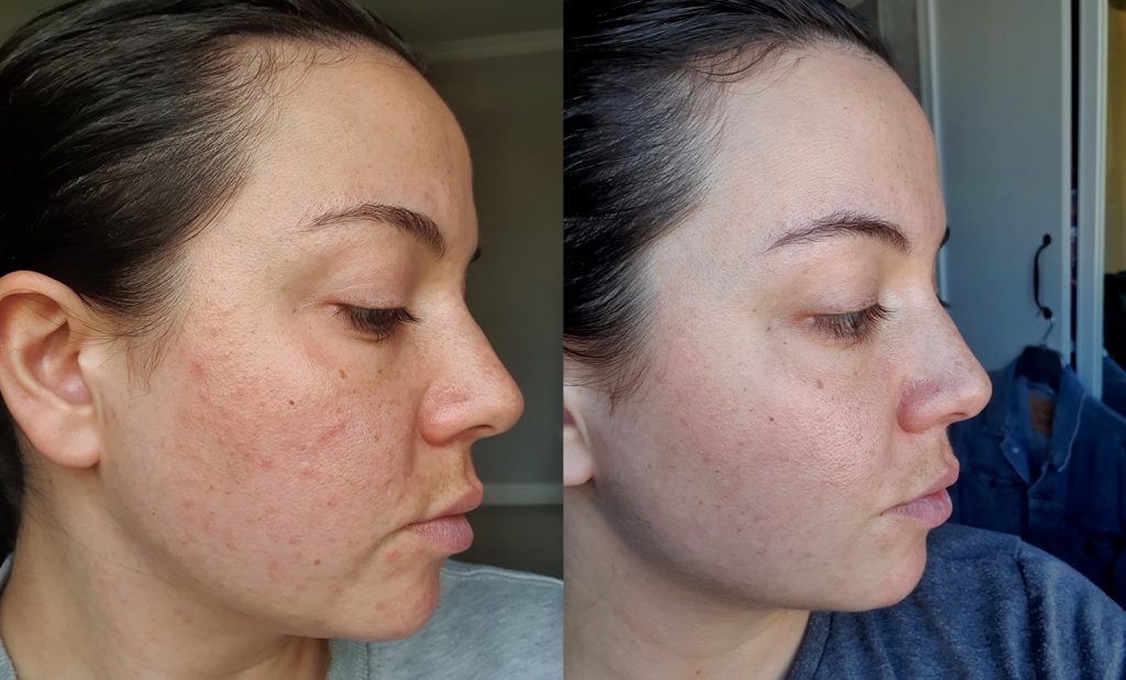 Acne Skin Journey: Lyndsey, 32, Yorkshire
