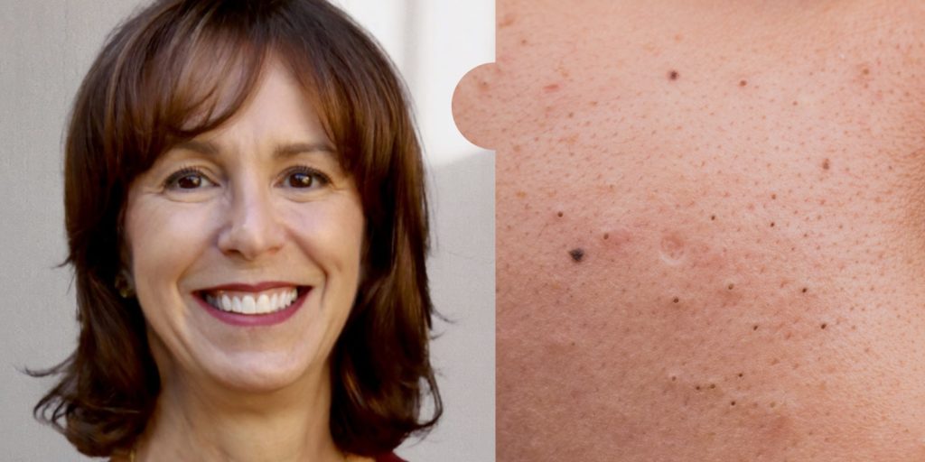 Ask a Derm: Why Do Some Adults Experience Acne?