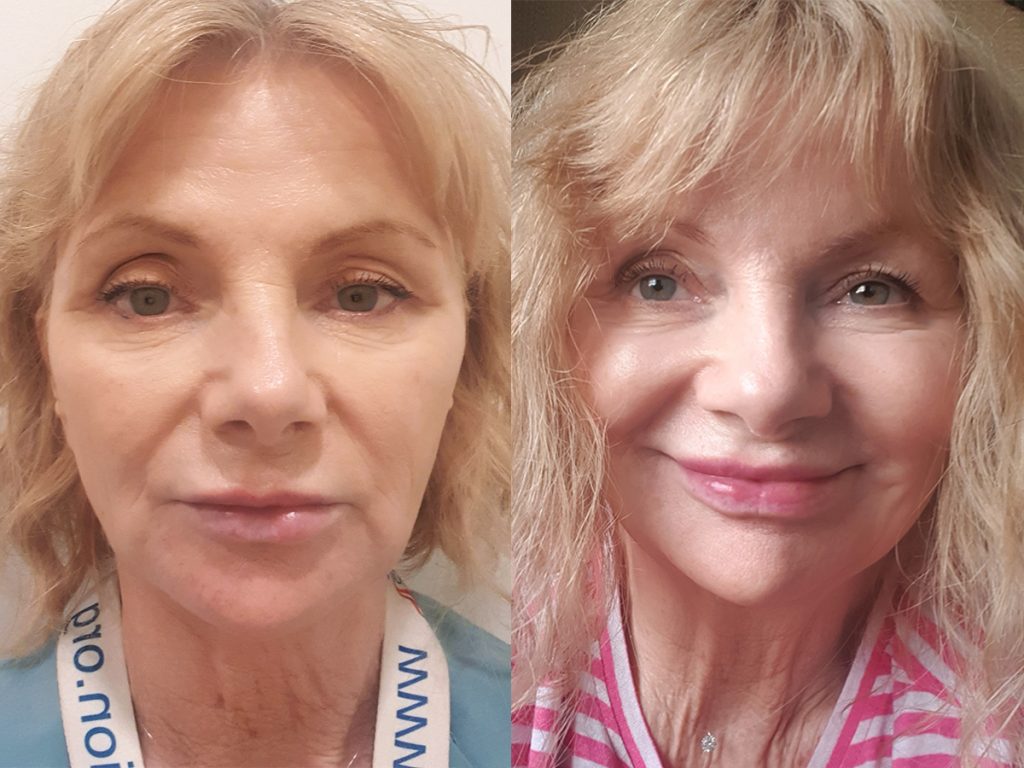 Anti-Ageing Skin Journey: Carole, 63, Glasgow