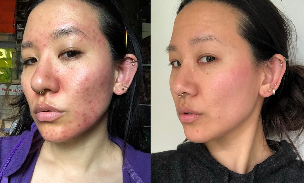 Acne Skin Journey: Sakiko, 37, London