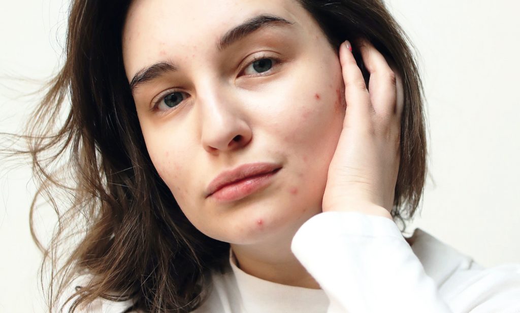 6 Of The Best Acne-Fighting Ingredients