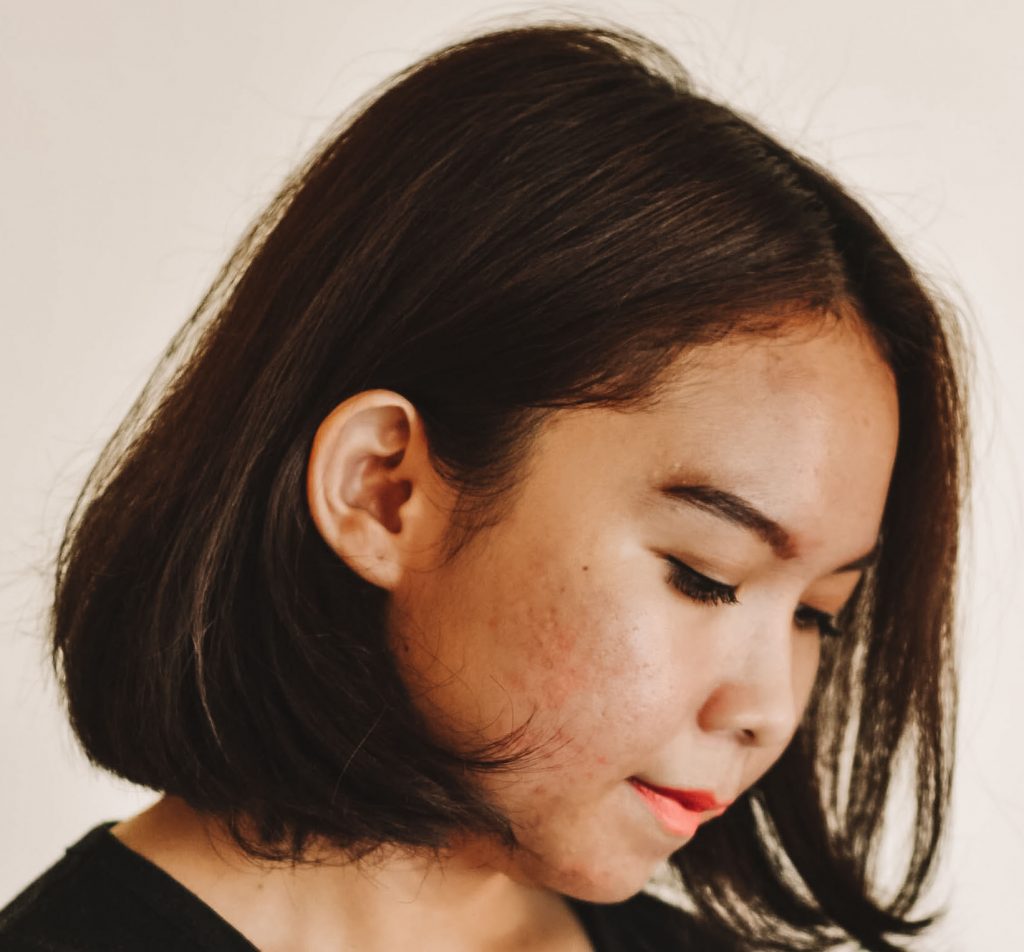In Focus: Azelaic Acid
