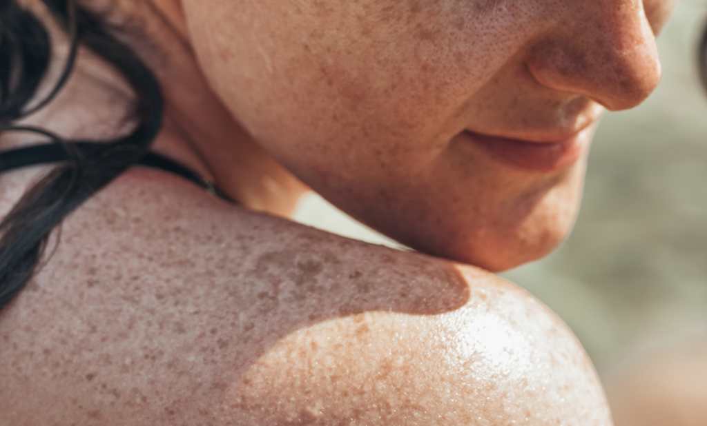 Everything You Need To Know About Hyperpigmentation