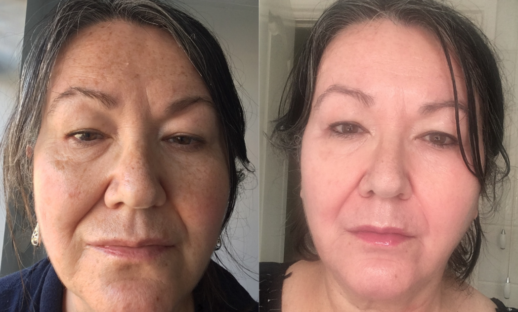 Hyperpigmentation Skin Journey: Melanie, 60, Wales