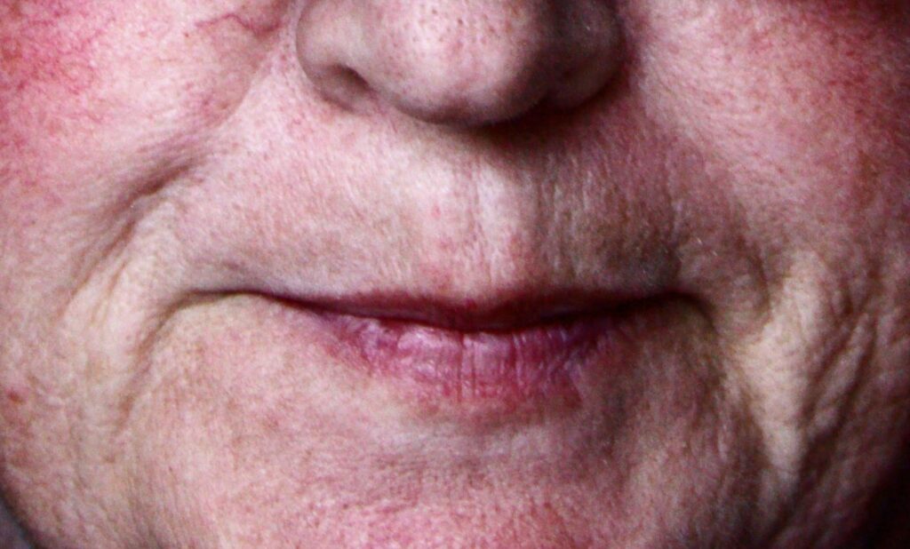 6 Easy Ways to Manage Winter Rosacea