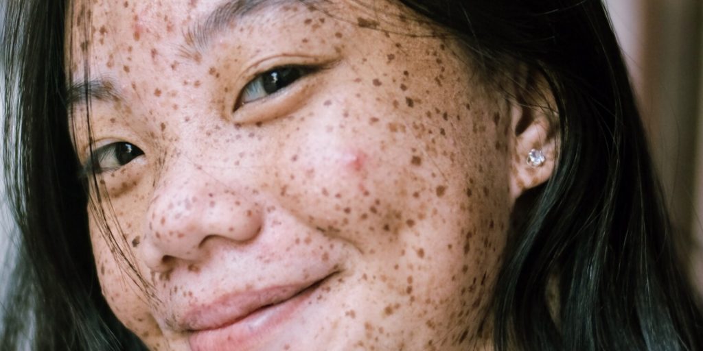 Retinoids: Why Skin Purges And How Long It Lasts